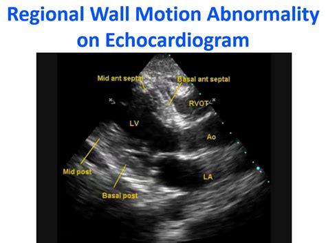 wall motion abnormalities on echocardiogram.